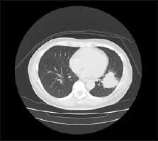 左下葉肺Ca CT