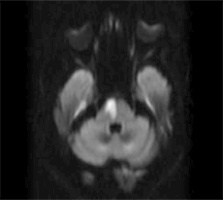 橋右側急性期脳梗塞 MRI