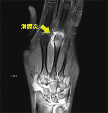 MRI造影画像