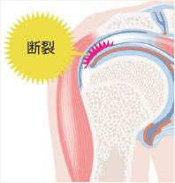 肩板の断裂図