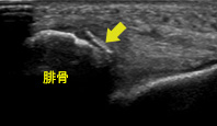 前距腓靭帯裂離骨折