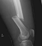 左大腿骨骨折X線画像