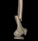 左大腿骨骨折（3D画像）
